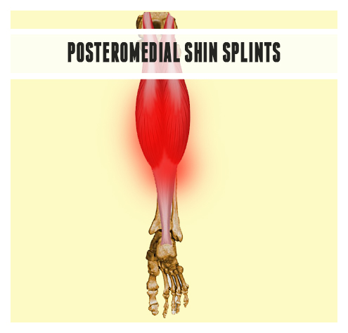 Ankle injury Posteromedial shin splints