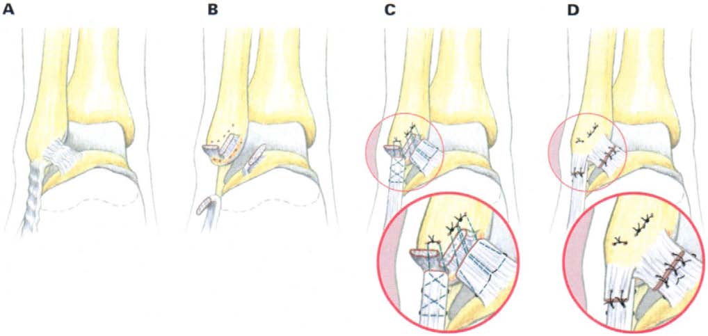 inversion sprain ankle injury